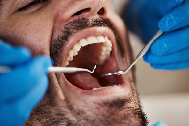 Best Knocked-Out Tooth Emergency  in Fairplay, GA